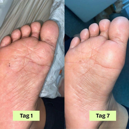 DermaFuss® – Fußpilz Stop Seife